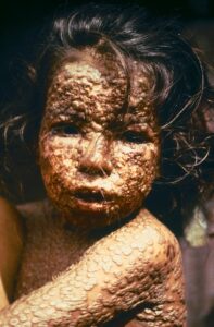 Smallpox was a disease that killed countless millions of people in a gruesome way that is now gone from the earth.